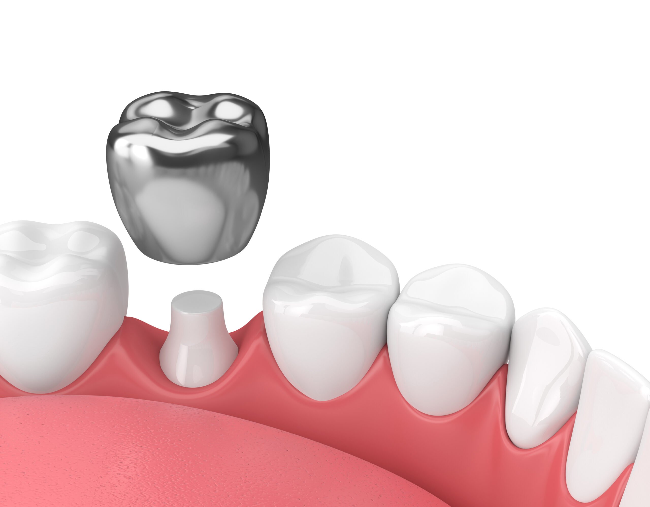 5 Common Myths Associated with Dental Crowns