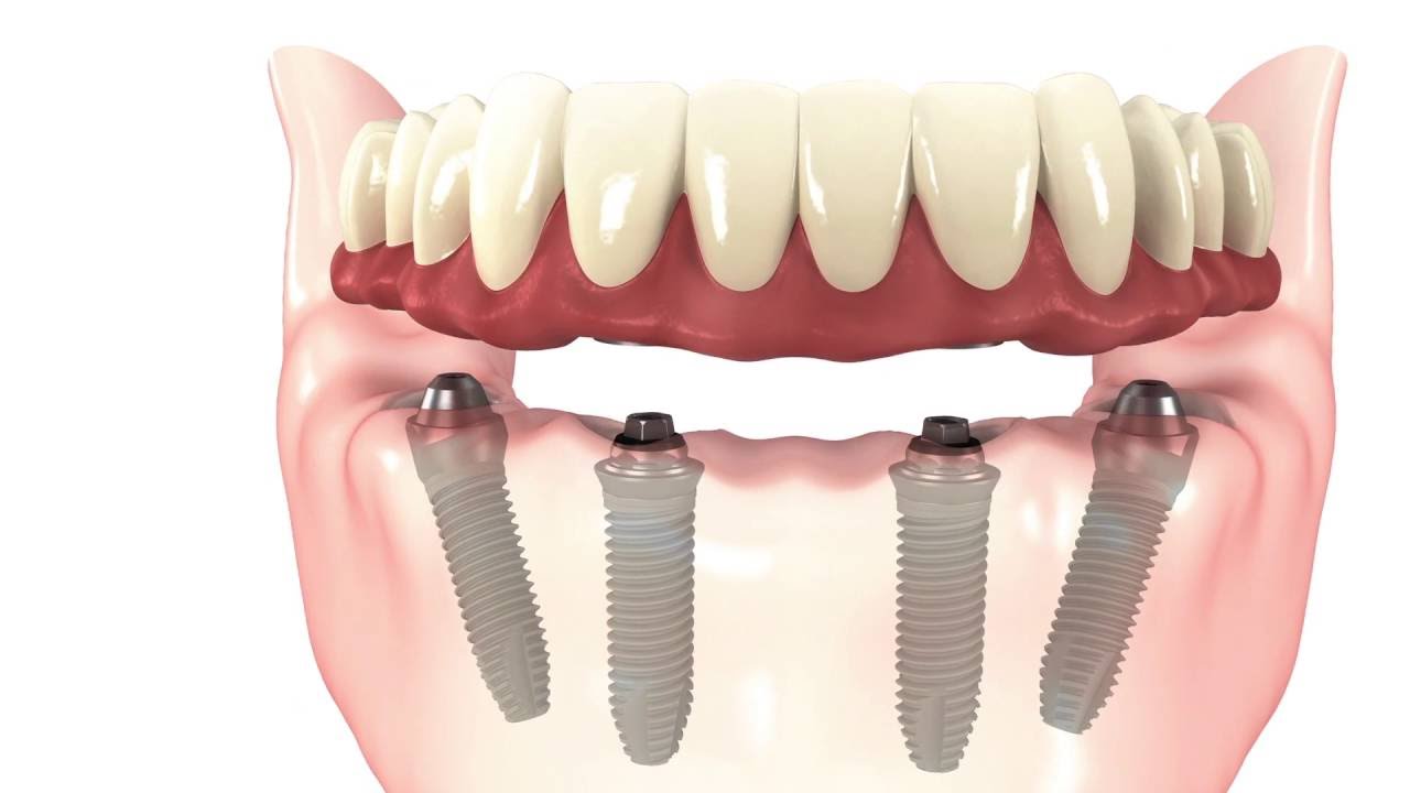 UNDERSTANDING ALL ON FOUR DENTAL IMPLANTS