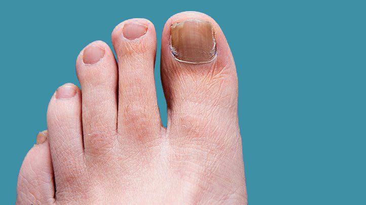 How to Prevent Toenail Fungus