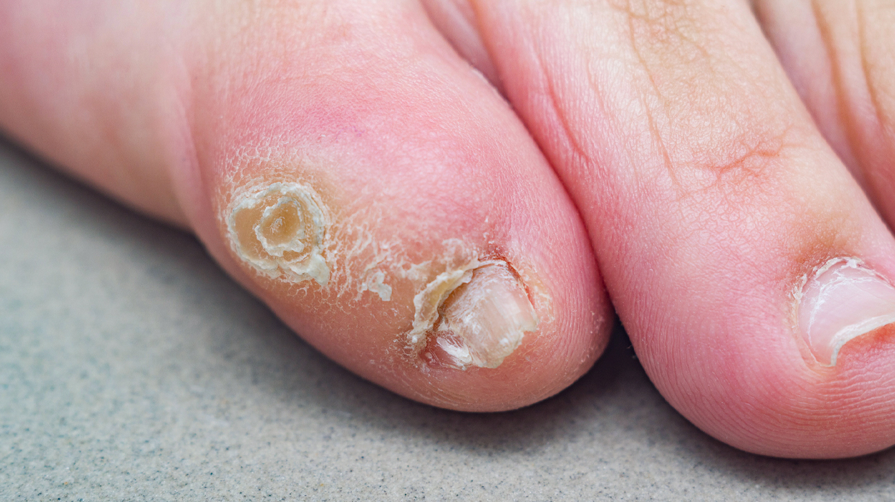 How to Treat Your Corns and Calluses?