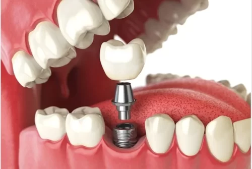 Why Are Dental Implants the Best Restorative Procedure for Your Teeth?