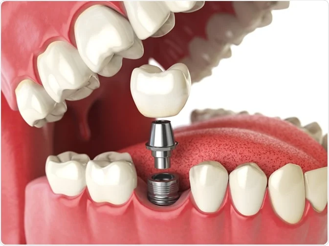 Why Are Dental Implants the Best Restorative Procedure for Your Teeth?