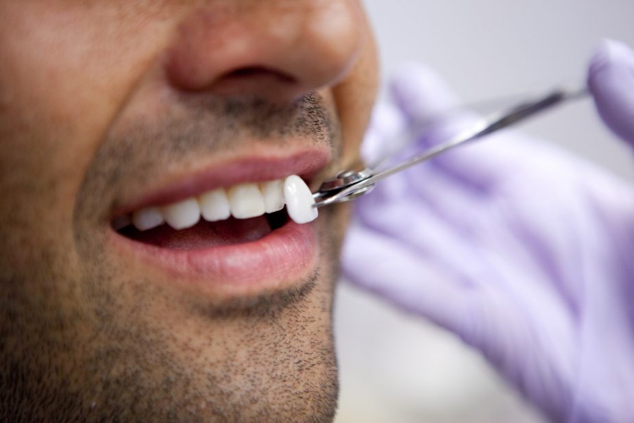 Cosmetic Dentistry 101: Key Questions About Porcelain Veneers Answered 