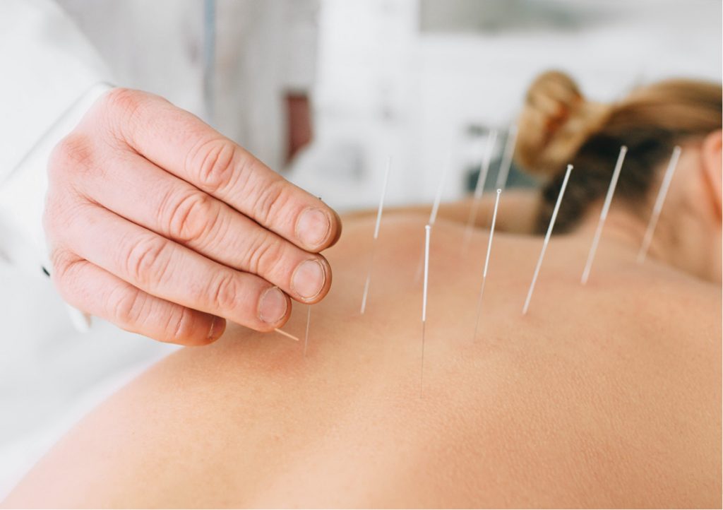 Health Benefits of Dry Needling