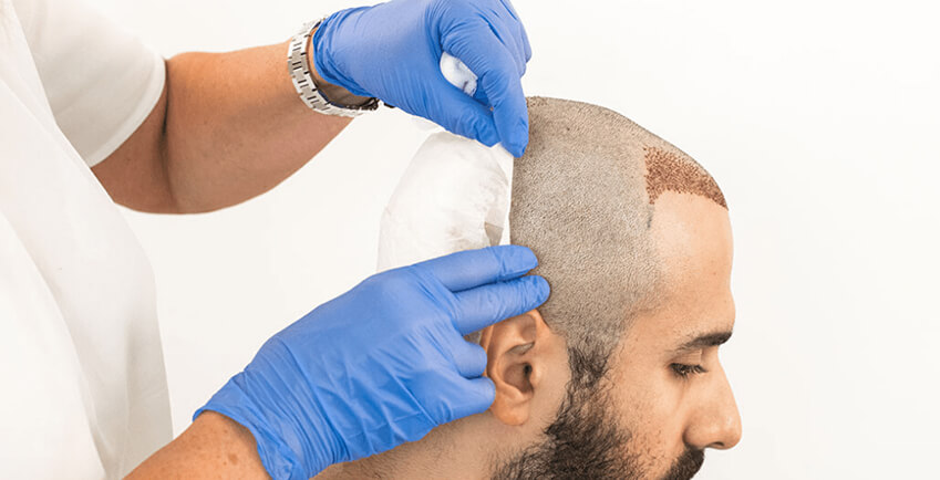 Hair Transplant Surgery- Benefits Everyone Should Know!