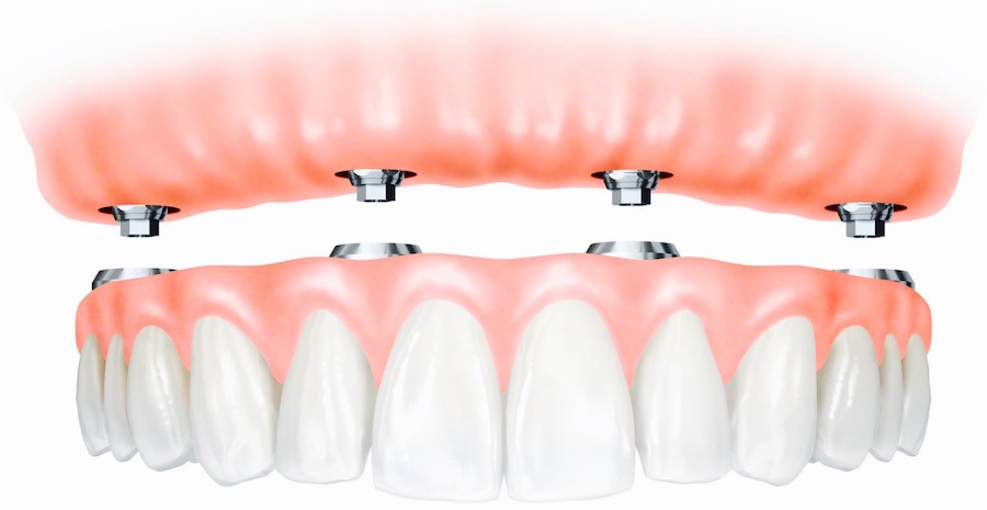 Implant-Supported Dentures: Boosting Your Confidence and Improving Your Quality of Life