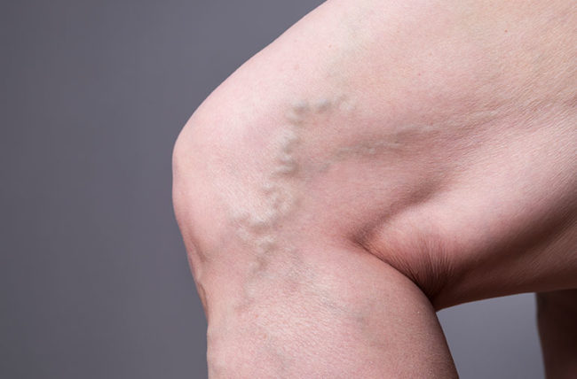 5 Ways To Reduce Discomfort Caused By Varicose Veins