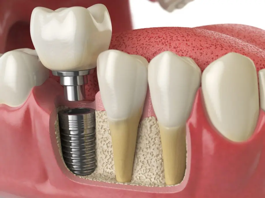 Full Mouth Dental Implant Procedures- The Obvious Option 