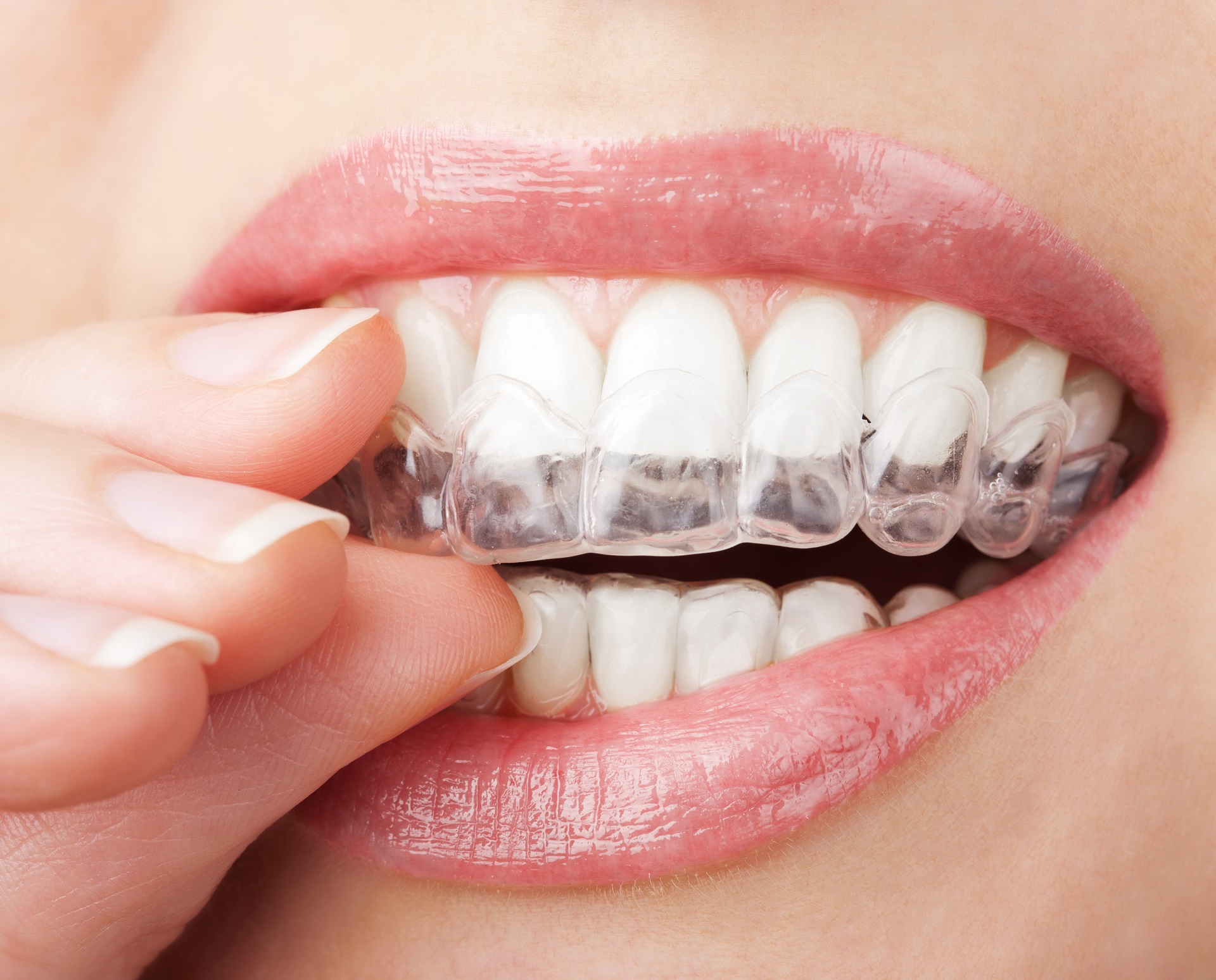 Top 5 Benefits of Invisalign