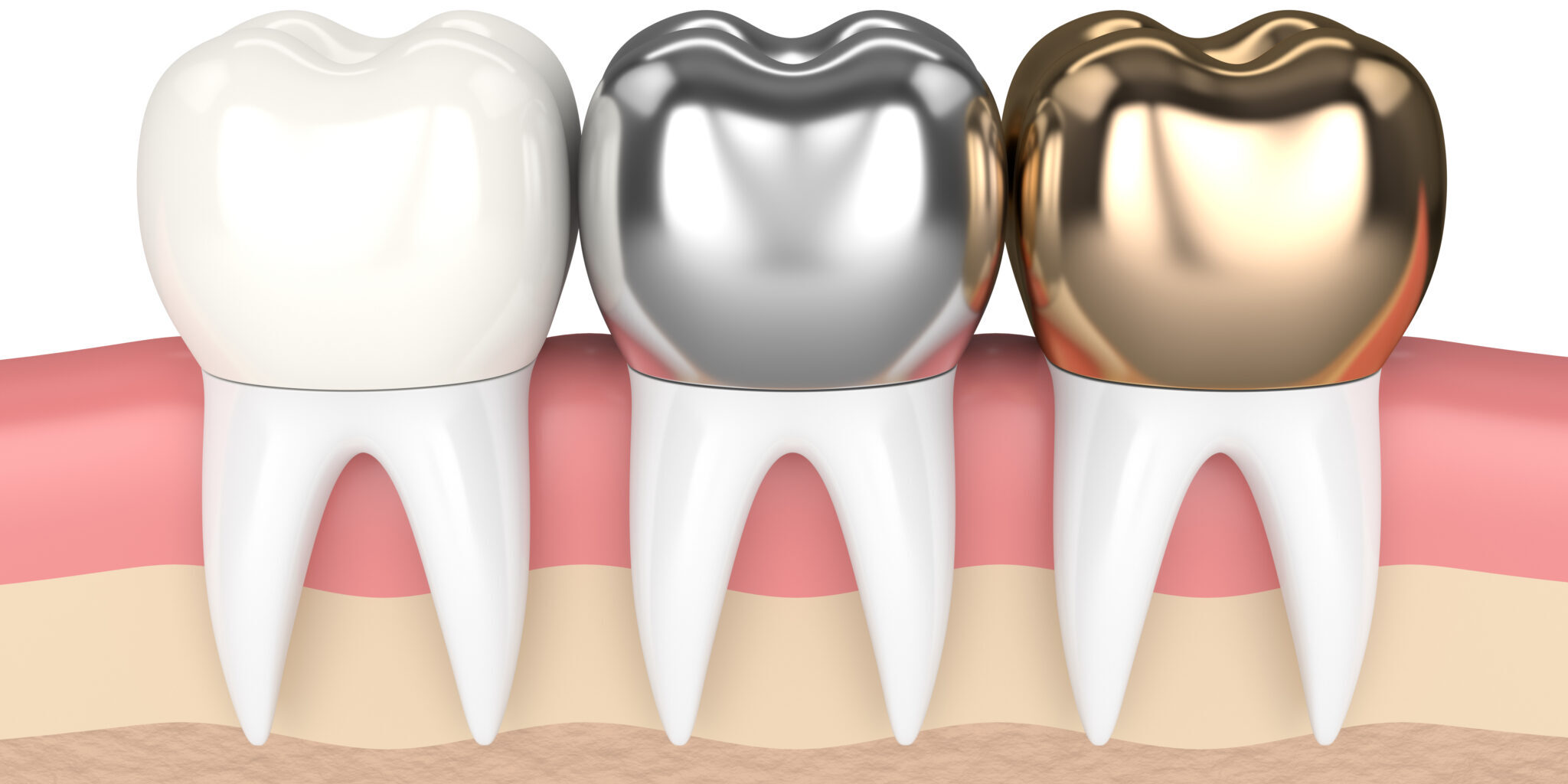 Check the advantages and disadvantages of dental crowns