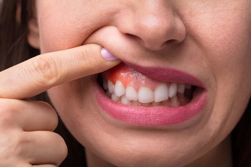 Top 6 Tips to Prevent the Risk of Developing Gum Disease