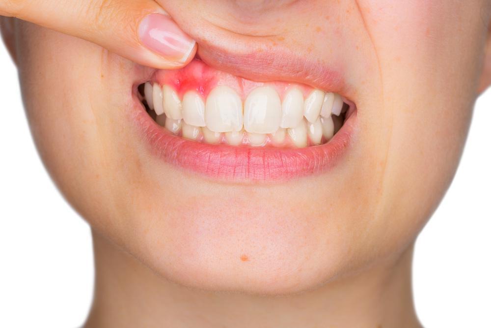 Top 6 Tips to Prevent Gum Disease