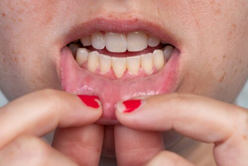 Causes of Gum Recession