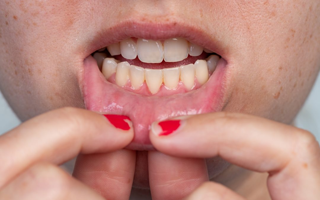 Causes of Gum Recession