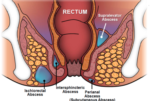 What are the Causes of Anal Fistula?