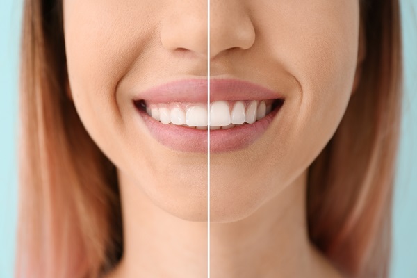 What is Gum Contouring, and What Are Its Benefits? 