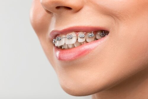 How to Care for Your Teeth and Braces During Orthodontic Treatment