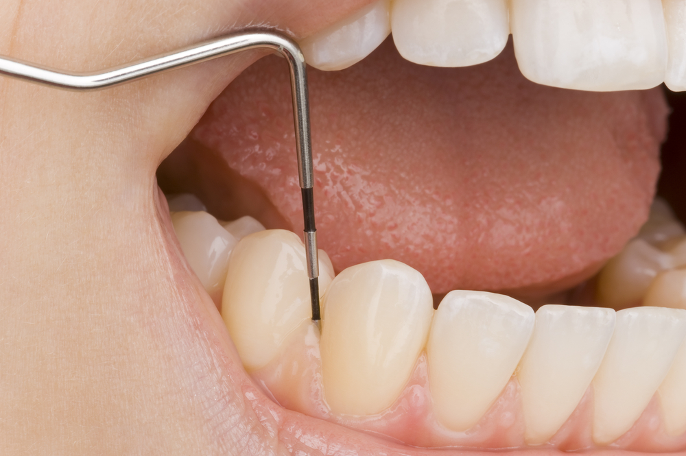 Preventing the Formation of Plaque for a Healthier Teeth and Mouth in Fort Walton Beach, FL