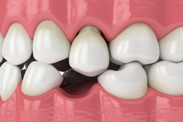 Tooth Loss in Tukwila: Why Replace Your Missing Teeth