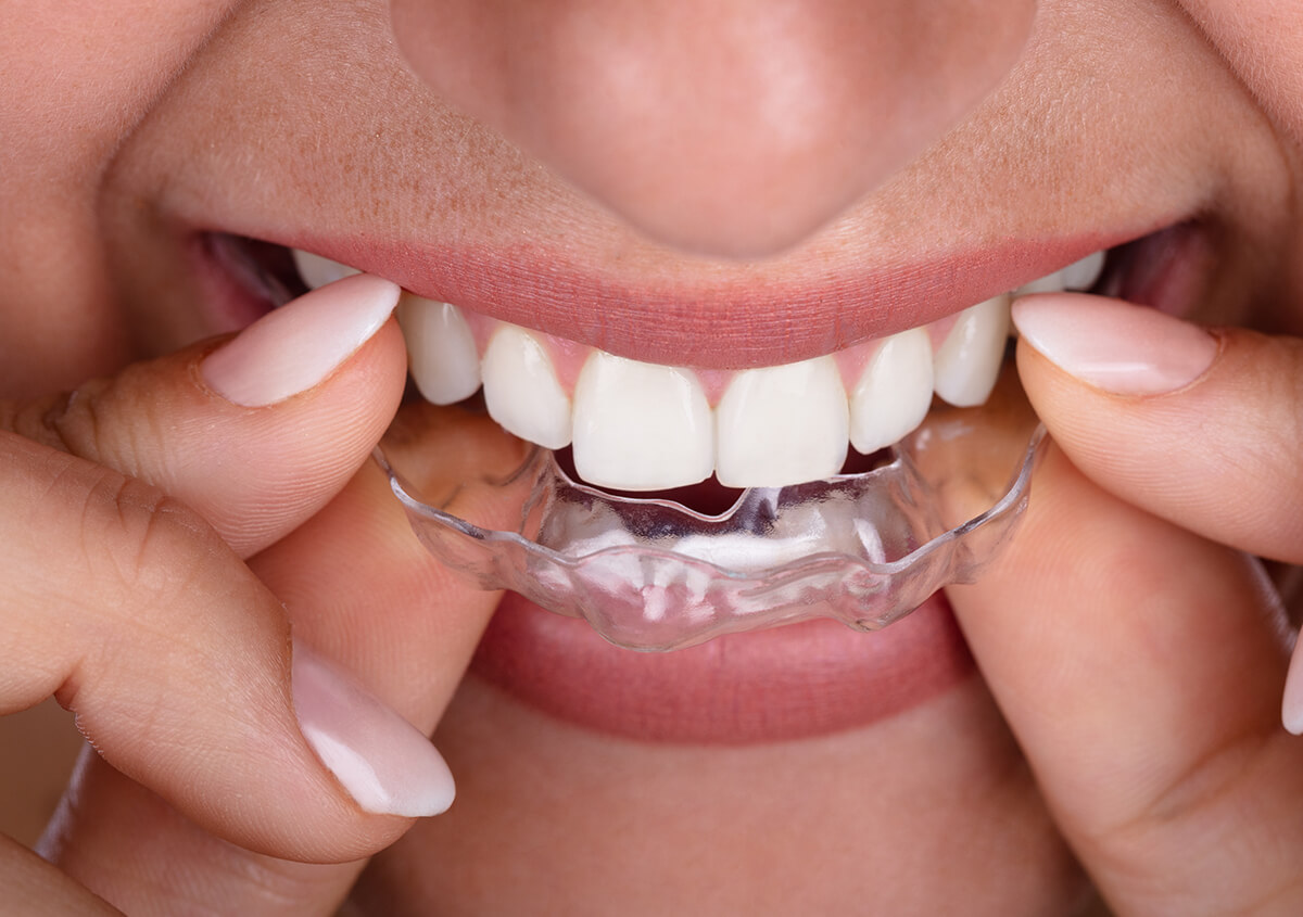 Three Things You Should About Dental Veneers in Richmond, IN