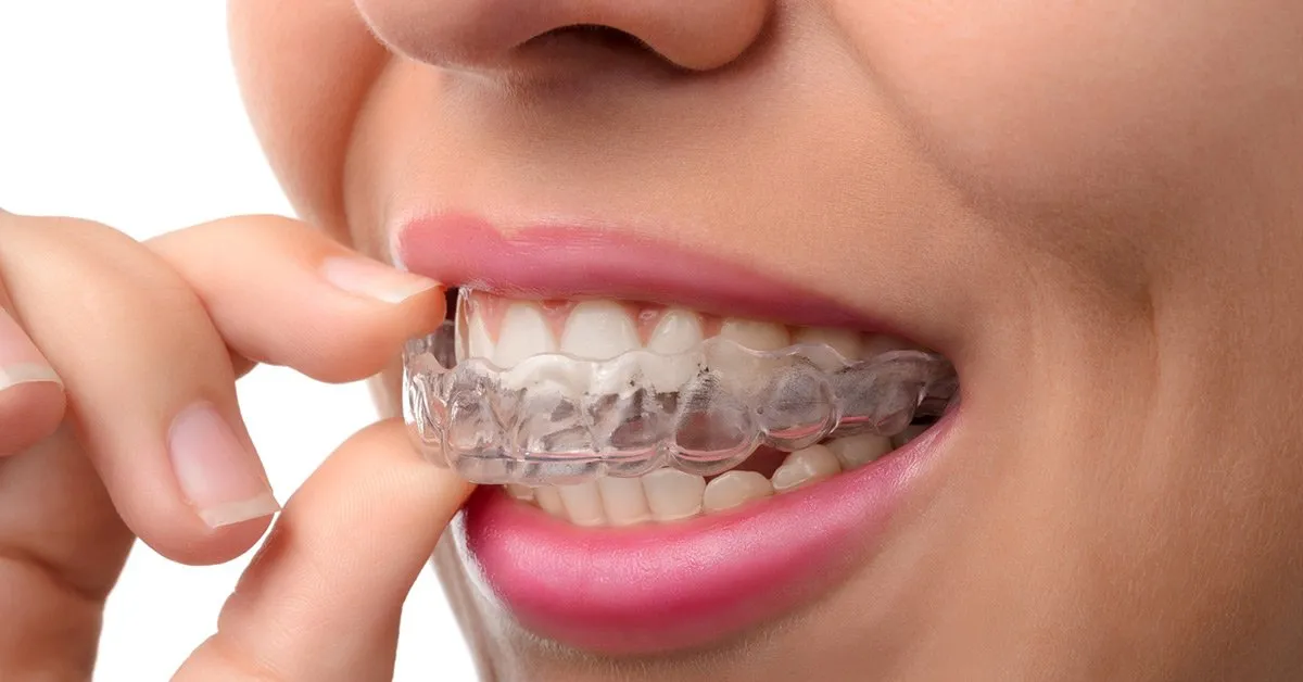 Why Should You Choose Invisalign Over Traditional Metal Braces?