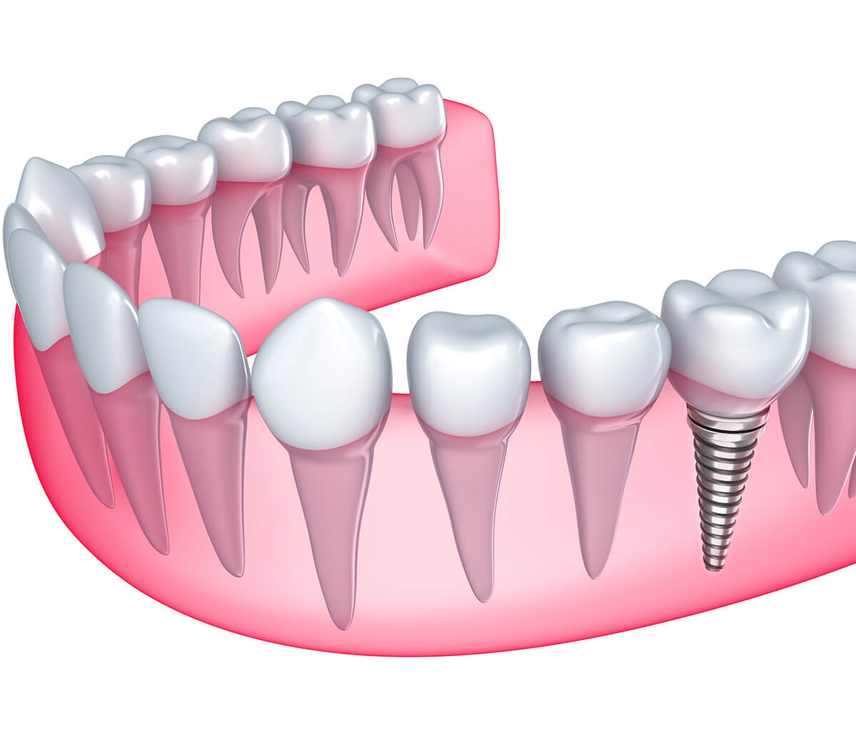 Why Missing Teeth Must be Replaced as Soon as Possible in Lakewood Ranch