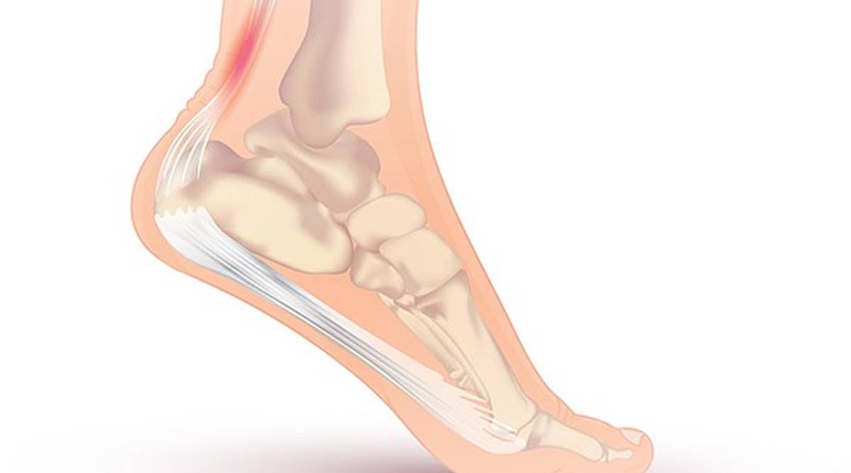 What to Know About Achilles Tendonitis: When to See a Specialist in Maryville, IL 