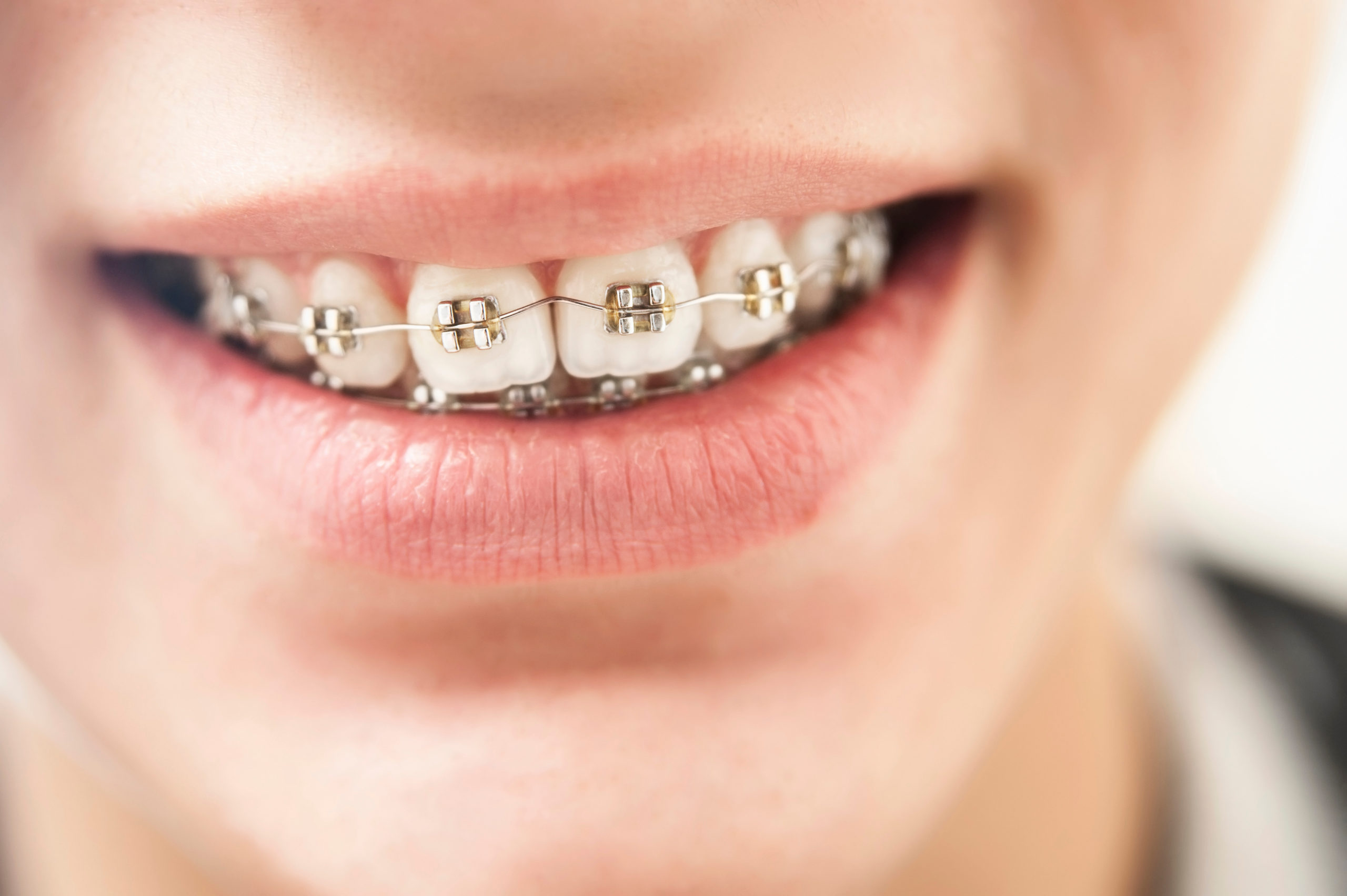 Braces Beyond Aesthetics: How It Can Improve Jaw and Speech Alignment