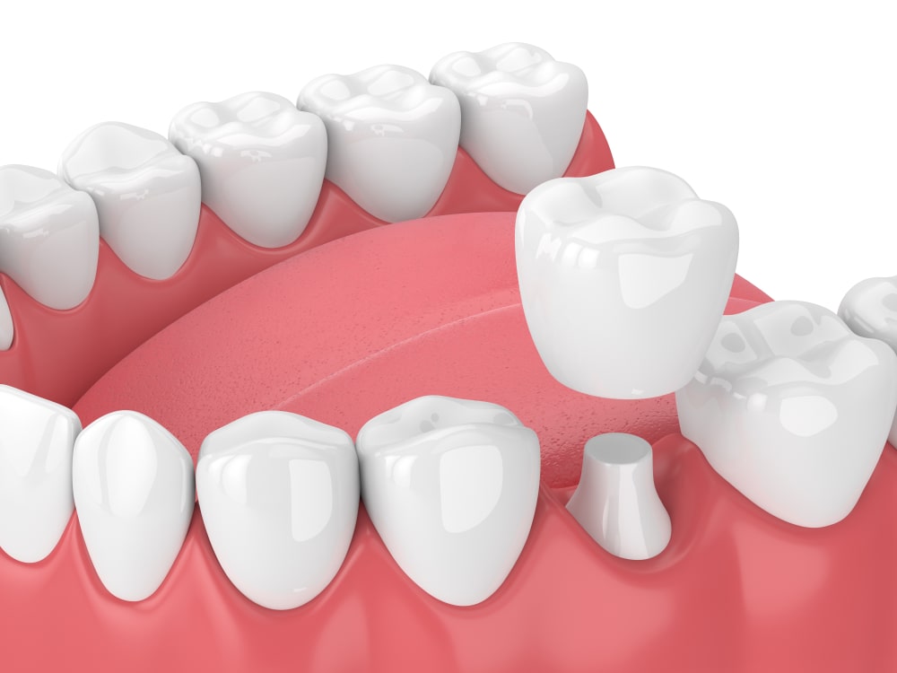 How to Know It’s Time to Replace Your Dental Crowns 