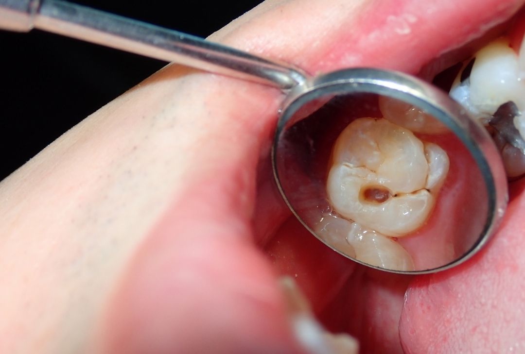 Diseases That Can Cause Tooth Decay