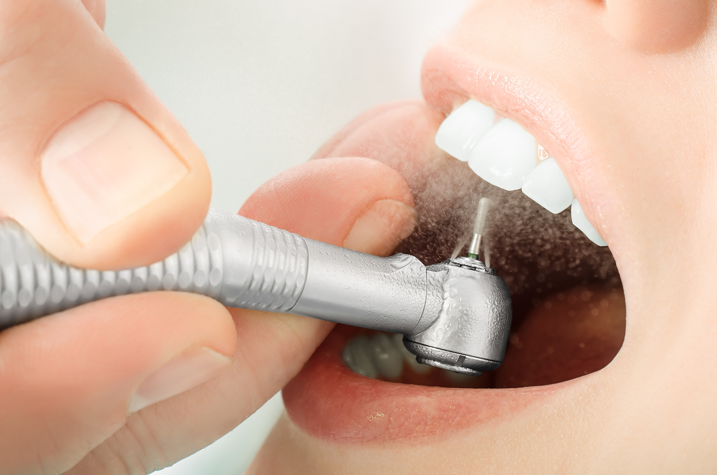 Composite Fillings: Widely Used Aesthetic Restorations