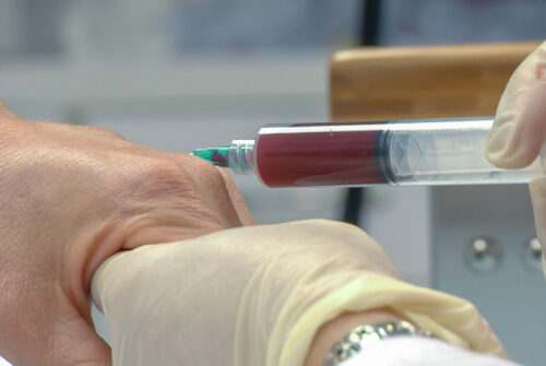 Be Aware of the Methods and Principles of Platelet-Rich Plasma Preparation 