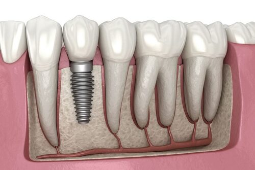 Dental implant recovery process – All you need to know 