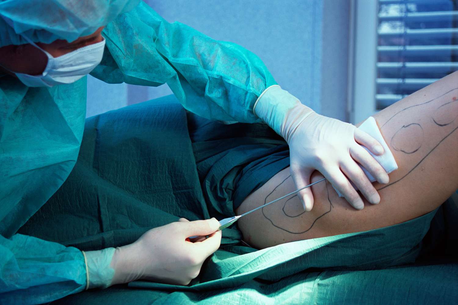 Removal of undesirable fat through cosmetic medical procedure: Liposuction