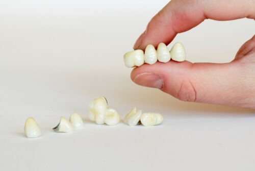 What are the Different Types of Dental Bridges?