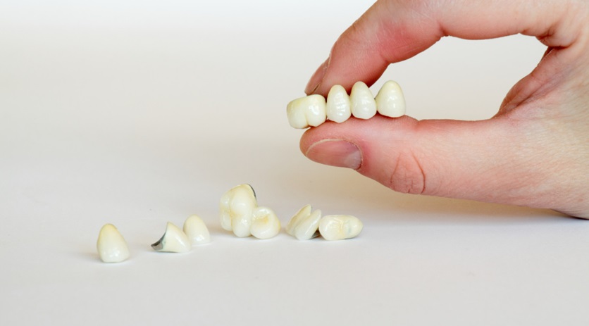 What are the Different Types of Dental Bridges?
