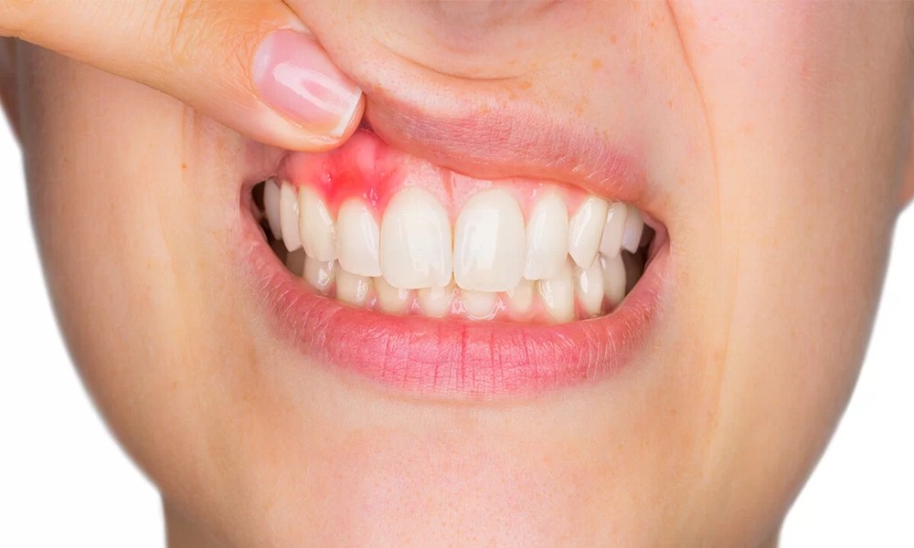 Can Dental Probiotics Support Your Healthy Gums?